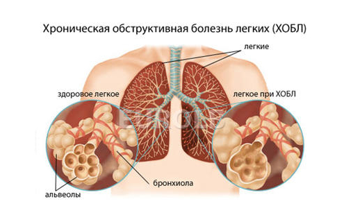 ХОБЛ