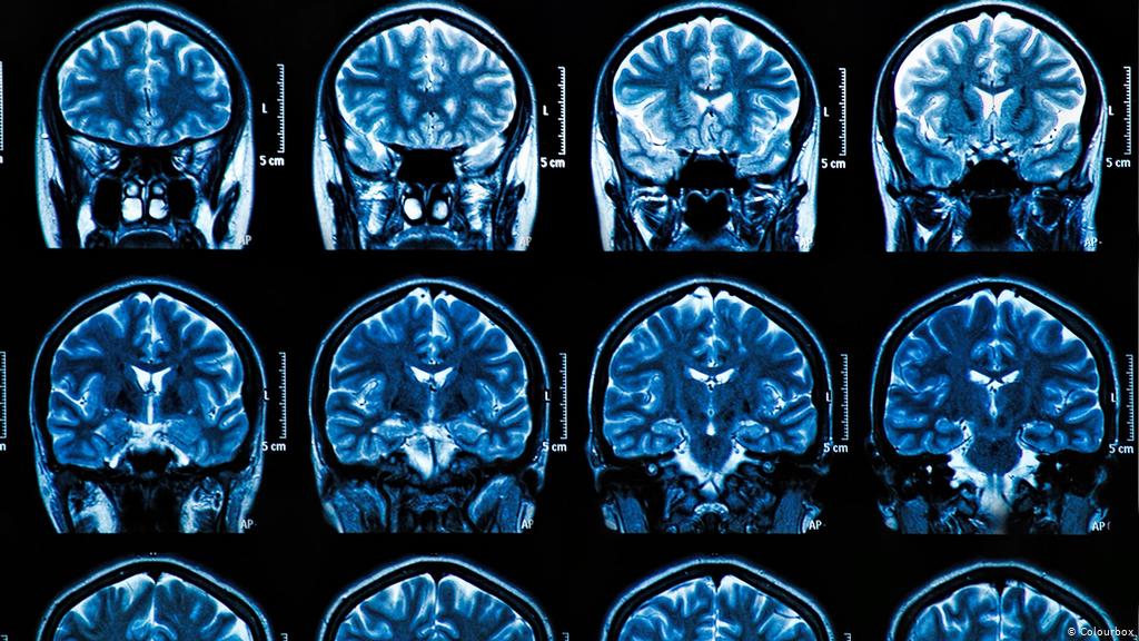 Изменение головного мозга при магнитно-резонансной томографии у пациента с коронавирусной болезнью 2019 (COVID-19) и аносмией