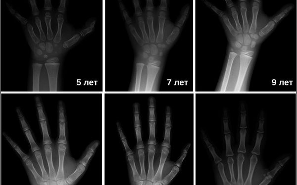 Методики определения костного возраста
