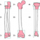 Классификации переломов трубчатых костей