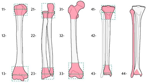 Классификации переломов трубчатых костей