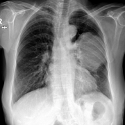 Рентгенограмма грудной клетки показывает четко очерченное крупное поражение в средней трети левого легкого.