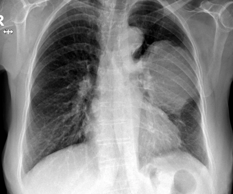 Рентгенограмма грудной клетки показывает четко очерченное крупное поражение в средней трети левого легкого.