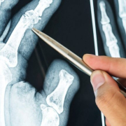 Рентгенологический метод заболеваний суставов