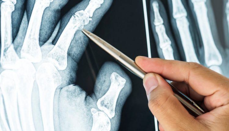 Рентгенологический метод заболеваний суставов