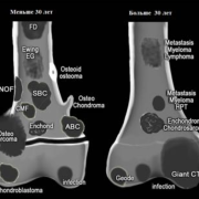 Неоссифицирующая фиброма (метафизарный фиброзный дефект)
