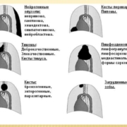 Опухоли средостения