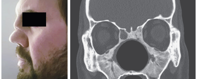 Деформация носа при гранулематозе с полиангиитом