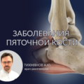 Патология пяточной кости 2 Zabolevaniya pyatochnoy kosti