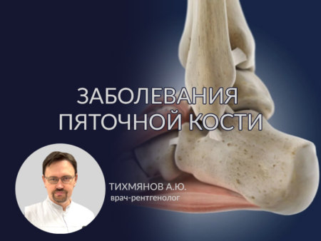 Патология пяточной кости 1 Zabolevaniya pyatochnoy kosti 2