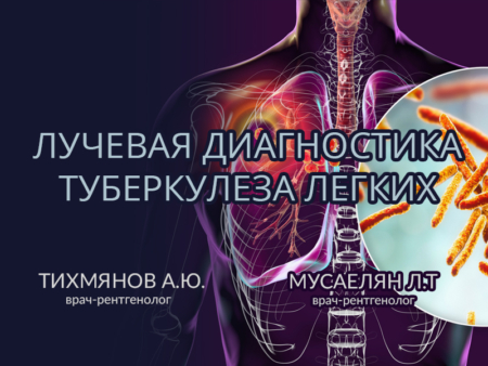 Лучевая диагностика туберкулеза легких