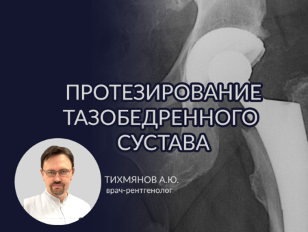 Эндопротезирование тазобедренного сустава 1 Protezirovanie sustava
