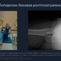 Эндопротезирование тазобедренного сустава 2 Slayd11