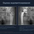 Эндопротезирование тазобедренного сустава 4 Slayd20
