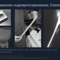 Эндопротезирование тазобедренного сустава 6 Slayd41
